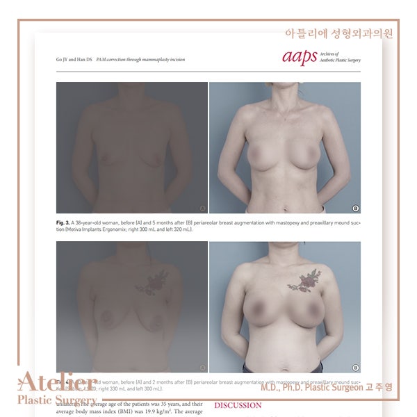 부유방제거 수술과 시술 중에서 고민한다면 사진 9