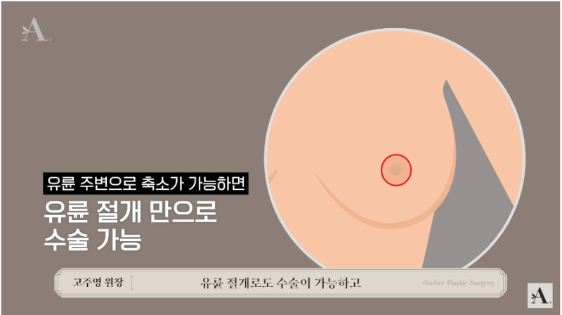 가슴 수술의 모든 것, < 가슴 축소 수술 > 2탄