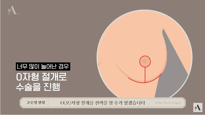 가슴 수술의 모든 것, < 가슴 축소 수술 > 2탄