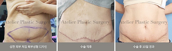 방배동 성형외과, 처진 뱃살 개선 과 복부 성형수술 사진 2