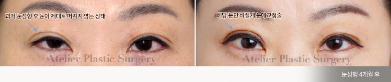 서래마을 성형외과, 아틀리에 성형외과 의 눈 수술 철학 사진 3