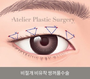 서래마을 성형외과, 아틀리에 성형외과 의 눈 수술 철학