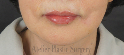 입필 맛집! 입술필러는 아틀리에 성형외과!