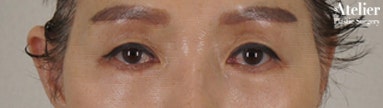 눈꺼풀 무거움을 느낄때는? 눈매교정술! 사진 3