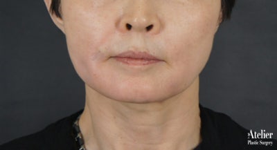 보형물이 필요없는 턱끝성형 사진 4
