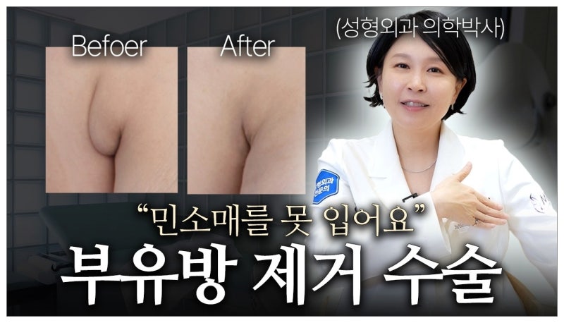 가슴거상술 부유방 빼기 제거 후기 가격 학동역 성형외과 확인하세요 사진 10