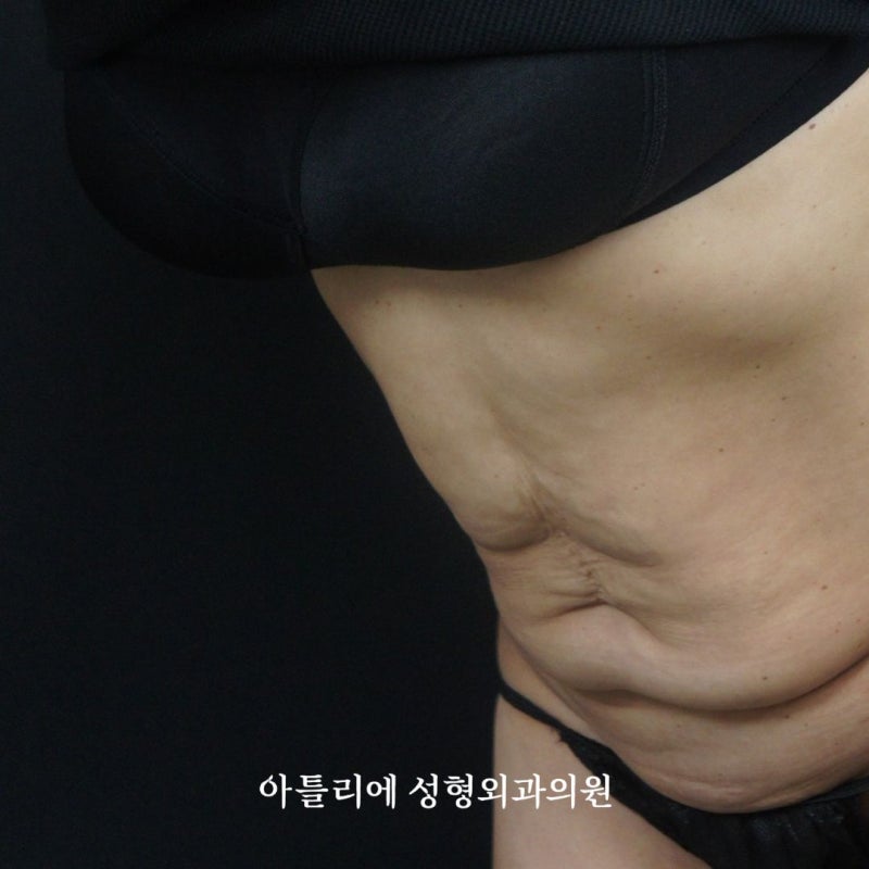 처진살 수술 복부거상 흉터 후기 찾고 있다면 확인하세요 사진 4