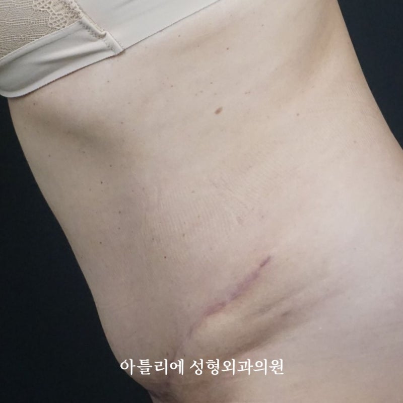 처진살 수술 복부거상 흉터 후기 찾고 있다면 확인하세요