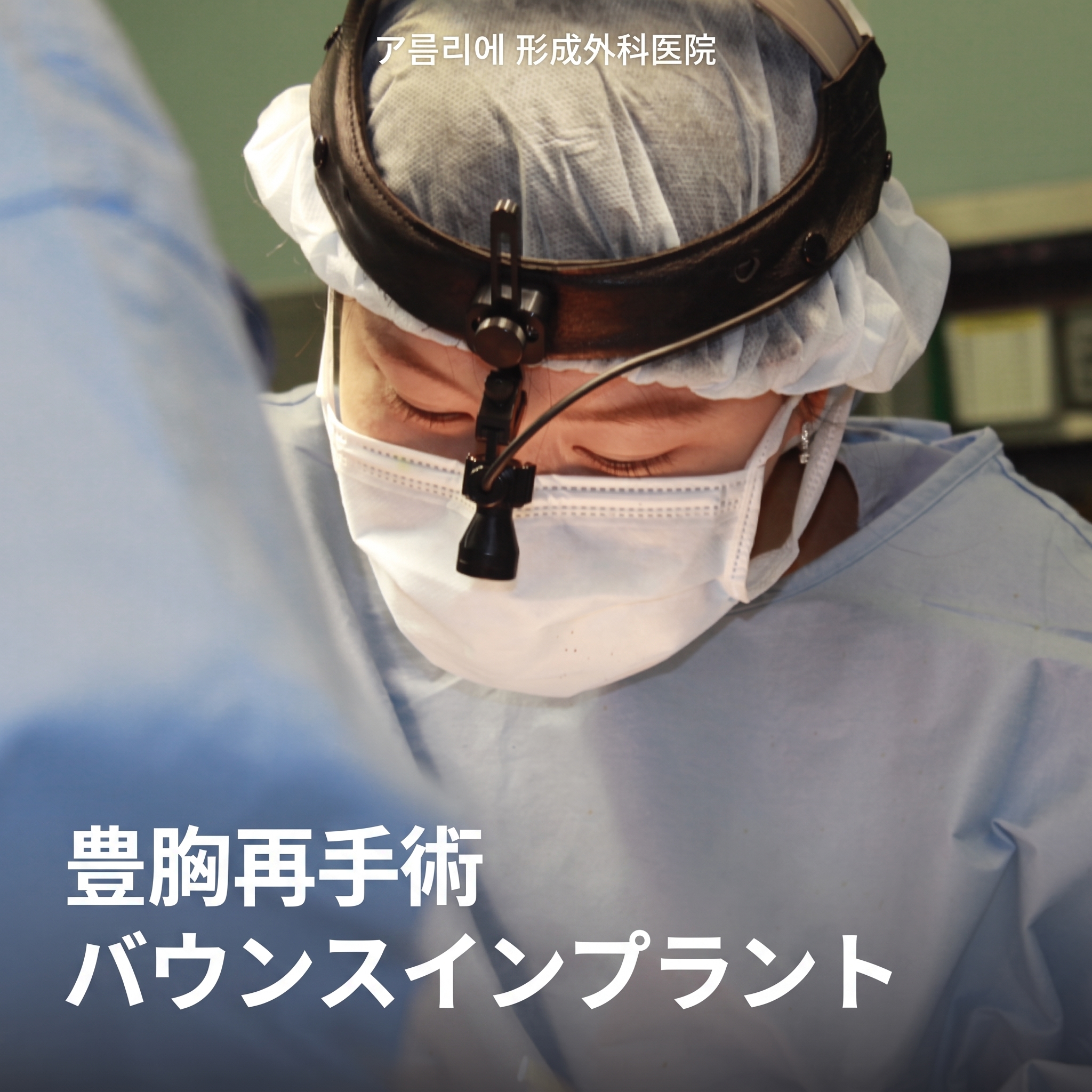 豊胸再手術の体験談・バウンスシリコンバッグ選びのポイント