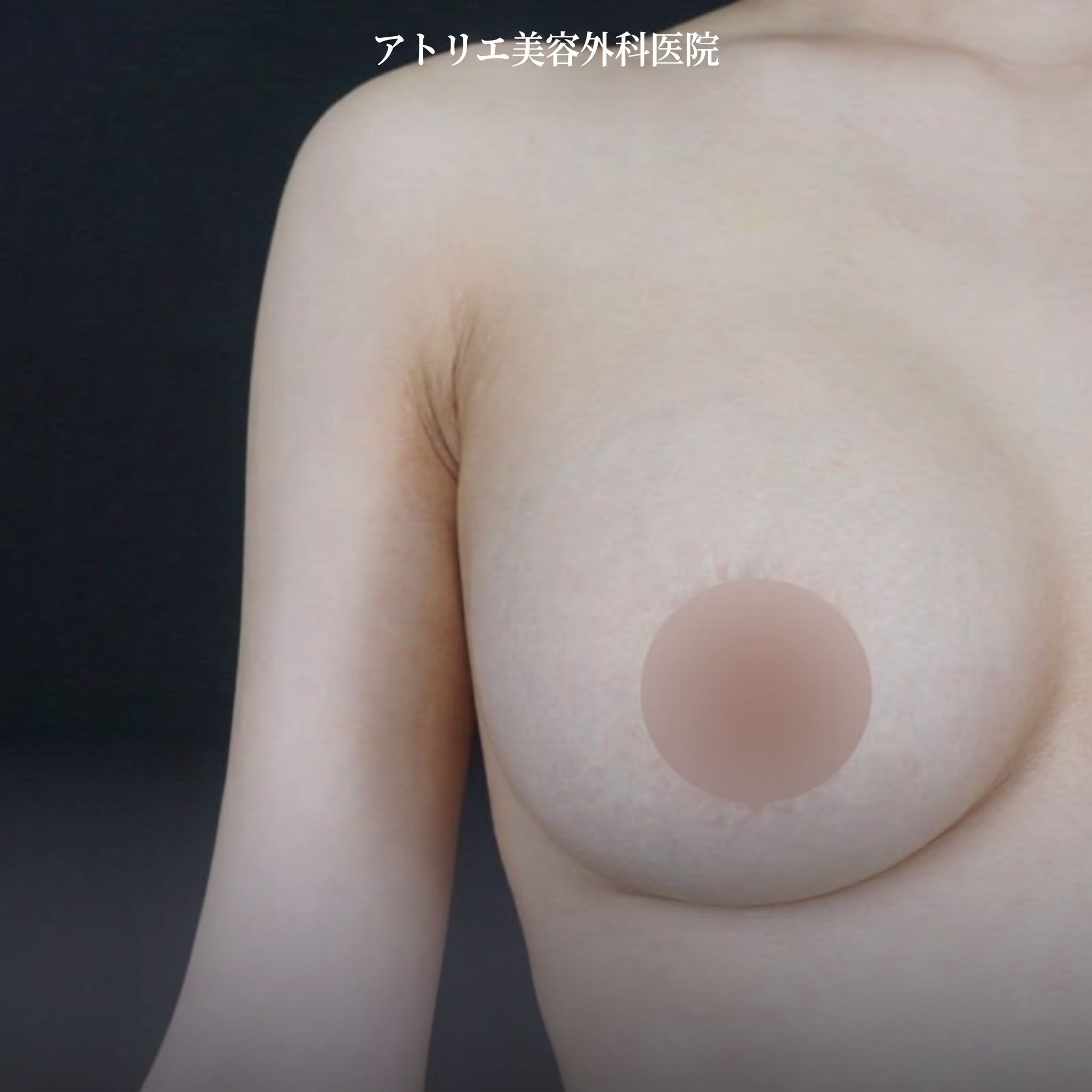 乳輪縮小・左右非対称胸の矯正・陥没乳頭手術費用、同時に可能? 사진 3