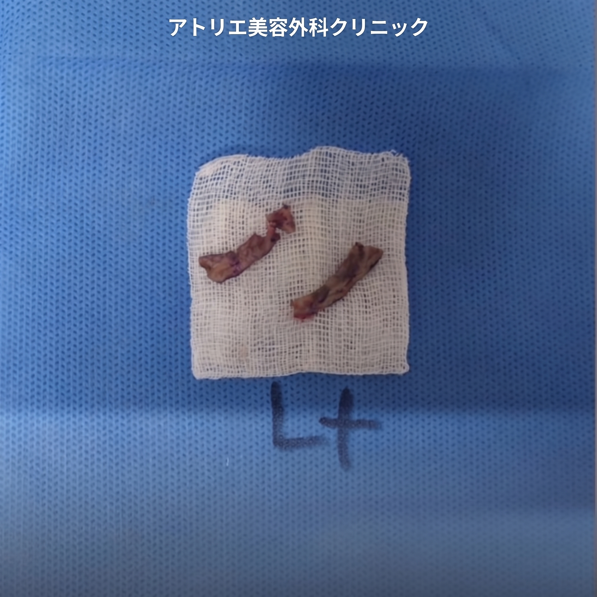 乳輪縮小・左右非対称胸の矯正・陥没乳頭手術費用、同時に可能? 사진 6