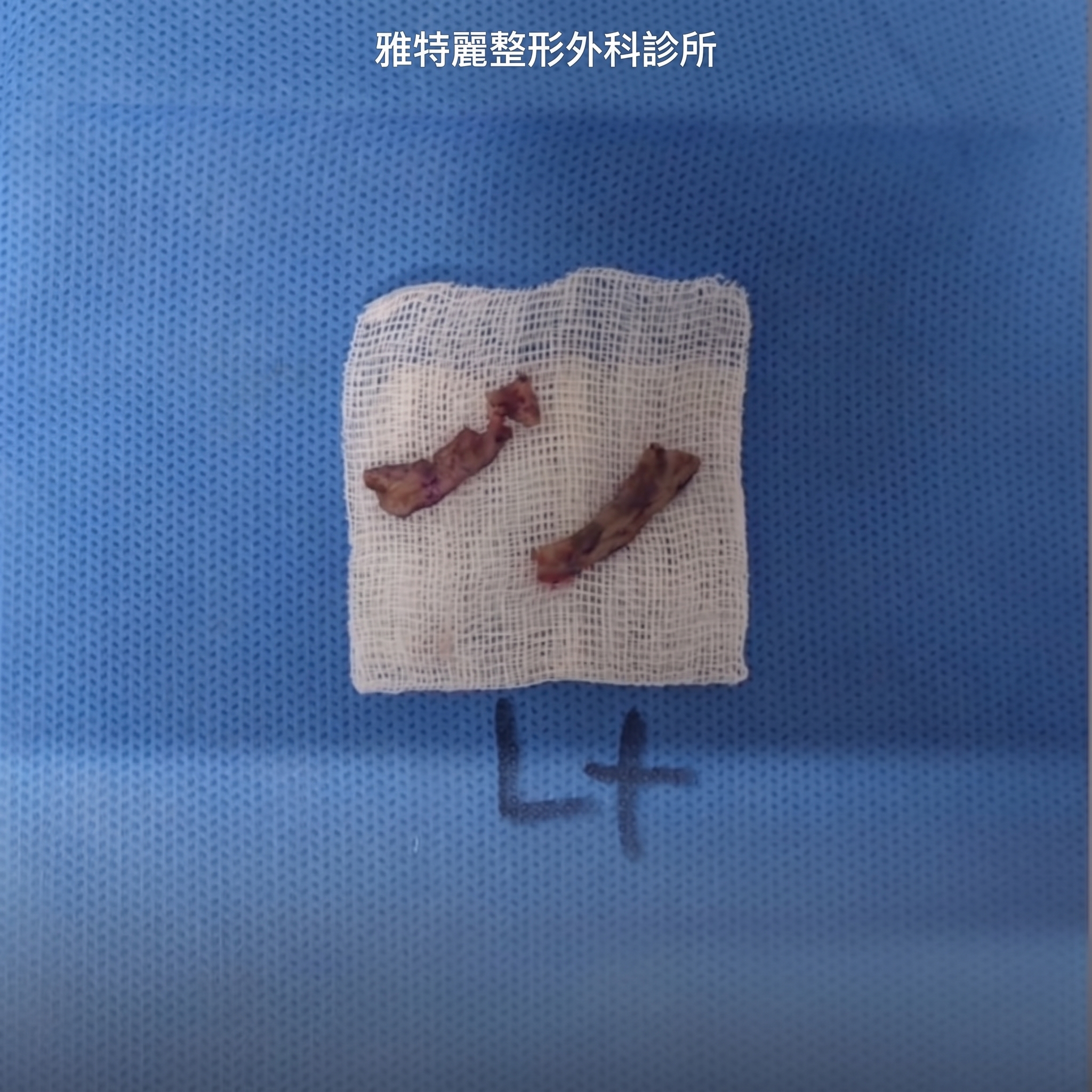 縮乳暈、大小奶矯正、凹陷乳頭手術費用，能同時改善嗎？ 사진 6