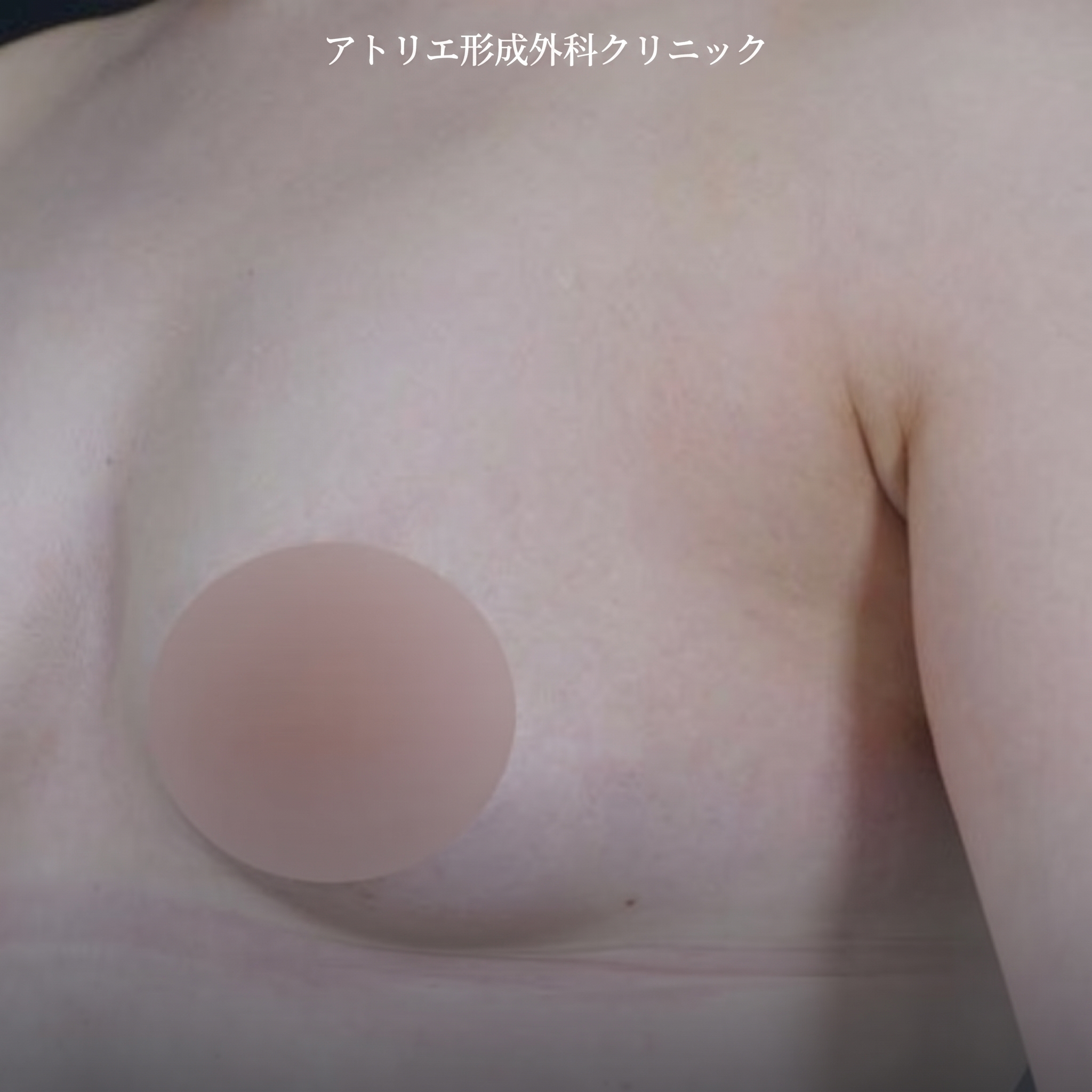 乳輪縮小・左右非対称胸の矯正・陥没乳頭手術費用、同時に可能? 사진 2