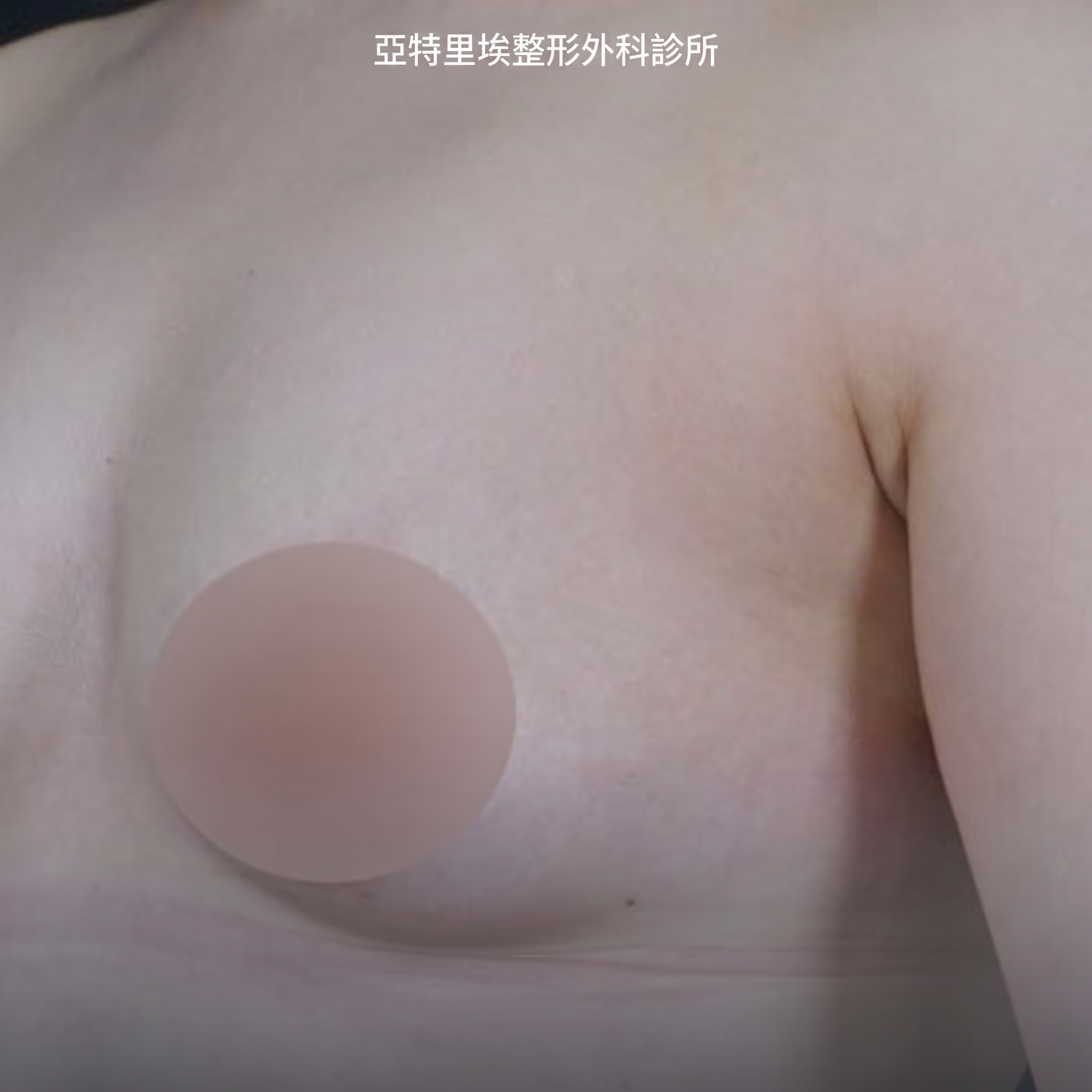 縮乳暈、大小奶矯正、凹陷乳頭手術費用，能同時改善嗎？ 사진 2