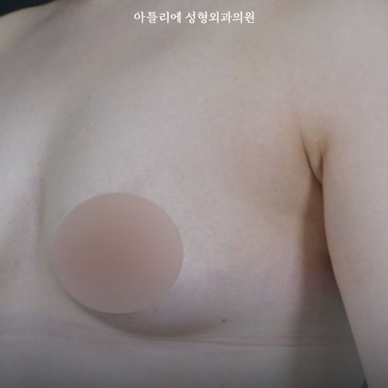 Areola Reduction, Asymmetrical Breast Correction, and Inverted Nipple Surgery: Can They Be Done Concurrently?