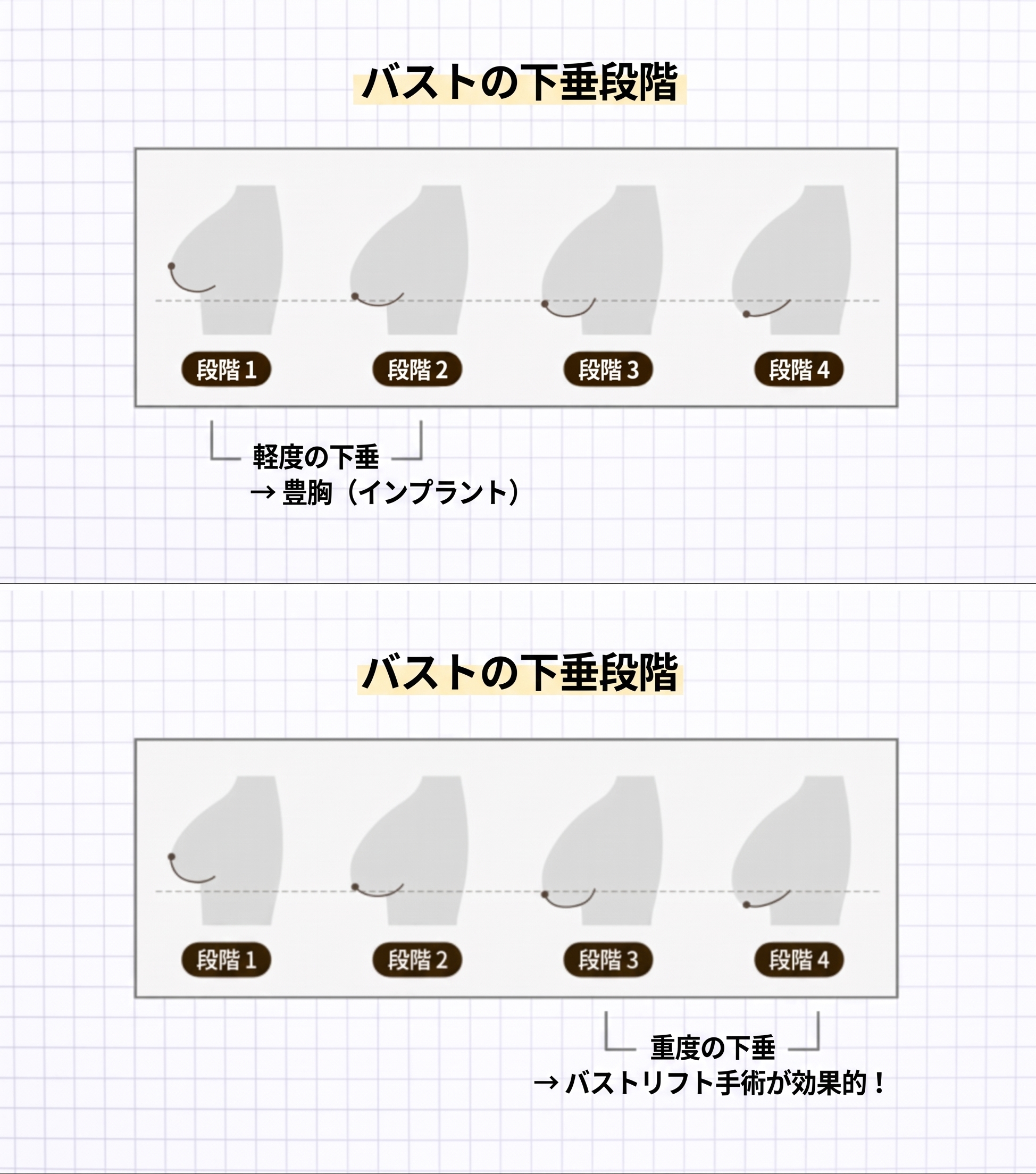 豊胸下垂修正術（乳房吊り上げ術）の傷跡・費用・垂れた胸を引き上げる前に知っておくべきこと 사진 2