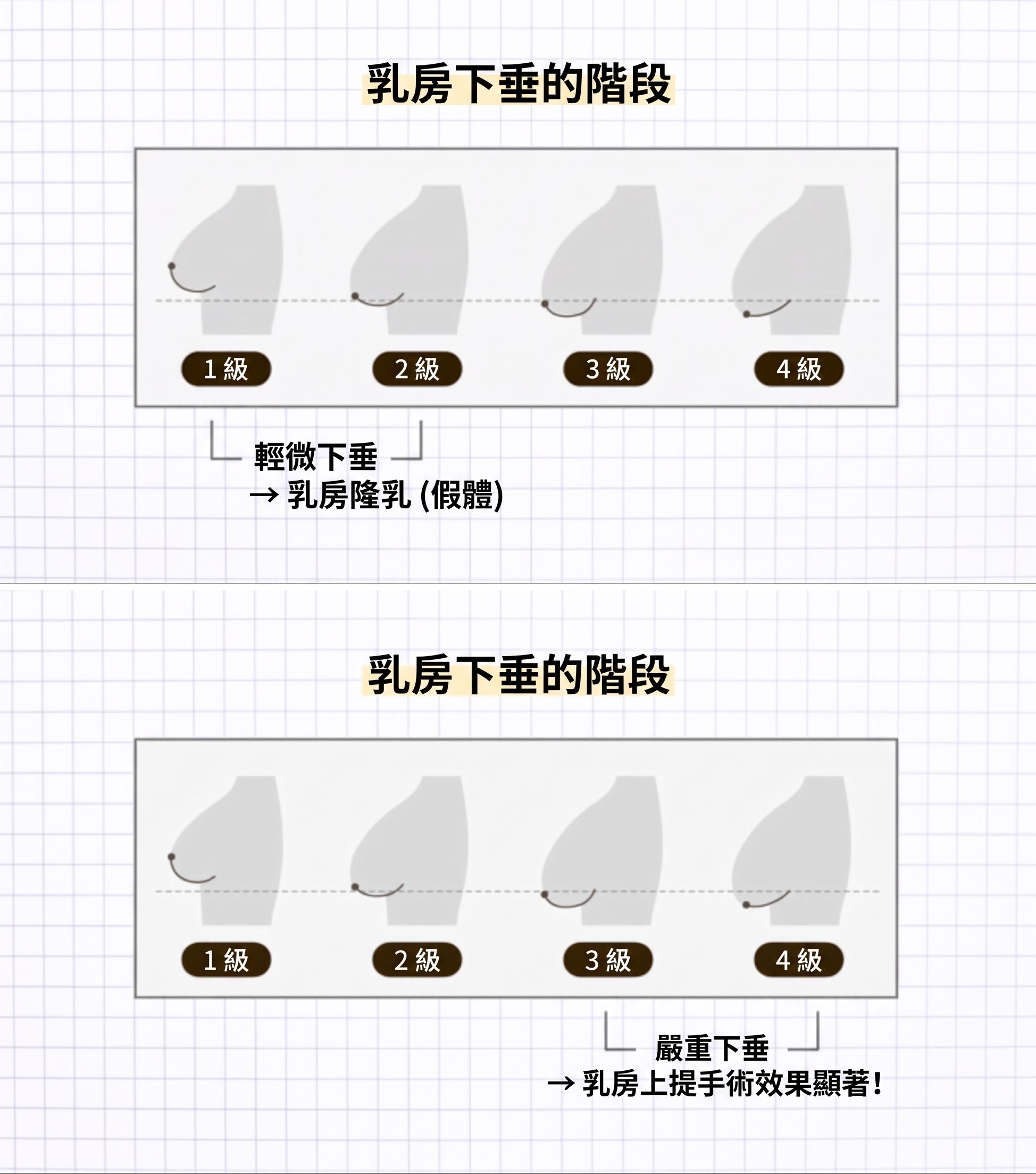 提乳手術疤痕與費用｜下垂胸部拉提術前必知要點 사진 2