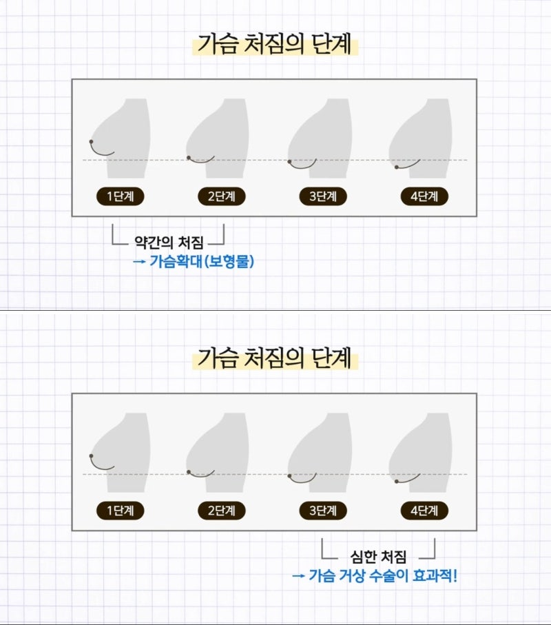 가슴거상술 흉터 비용 처진가슴 올리기 전 꼭 알아야 할 것 사진 2