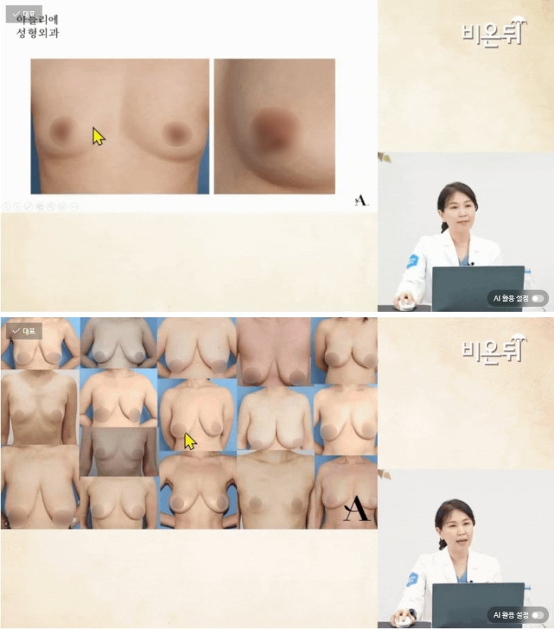 가슴성형 종류 모유수유 가능 여부 함몰유두수술가격 총정리 해드립니다 사진 2