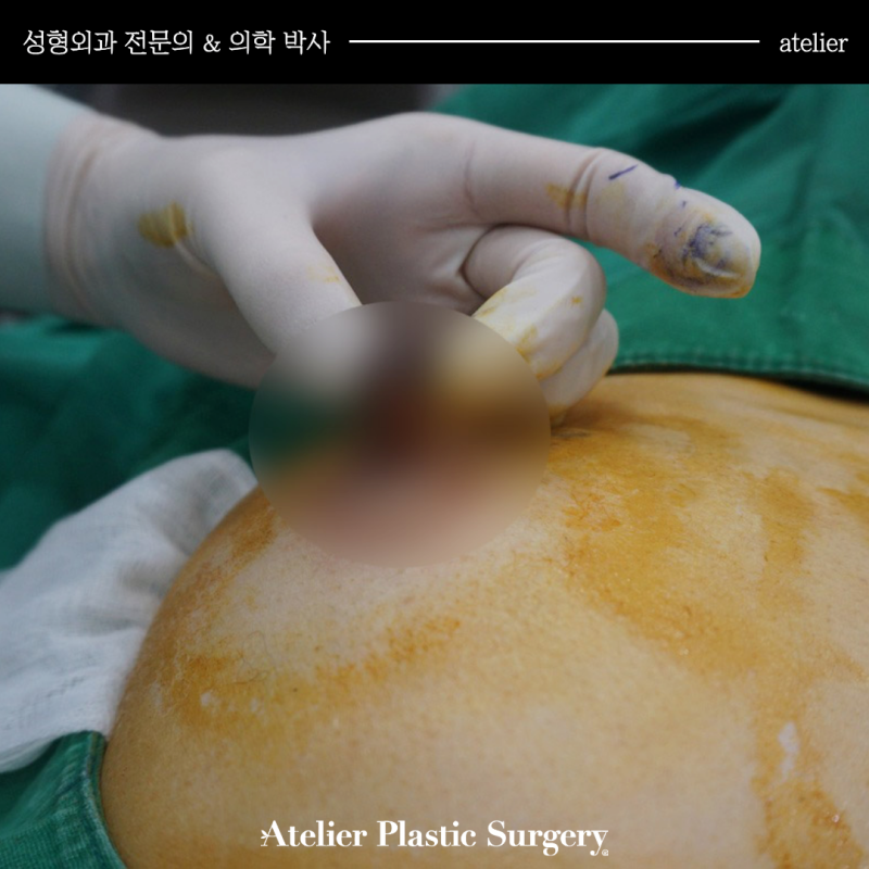 가슴성형 종류 모유수유 가능 여부 함몰유두수술가격 총정리 해드립니다 사진 10