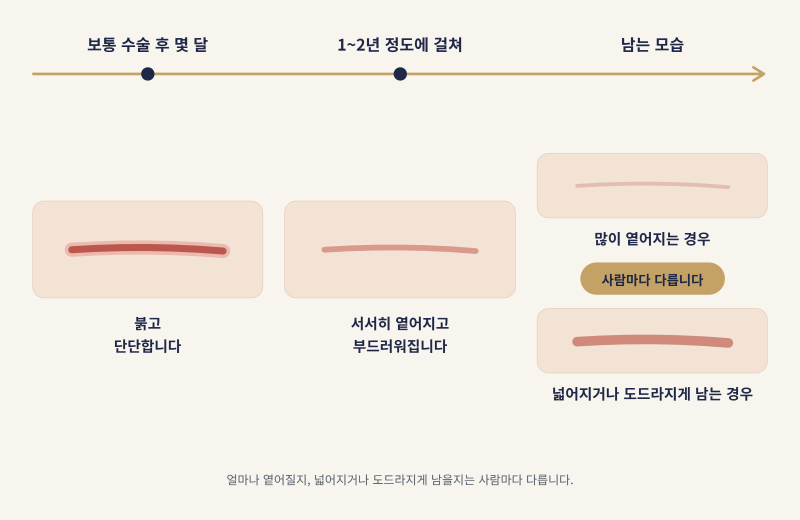 가슴축소수술 비용 후기 찾고 있다면 확인하세요 사진 6