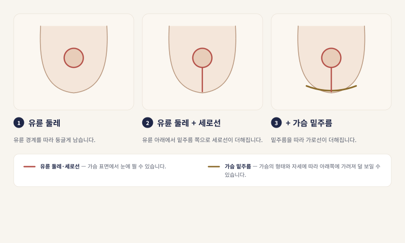 가슴축소수술 비용 후기 찾고 있다면 확인하세요
