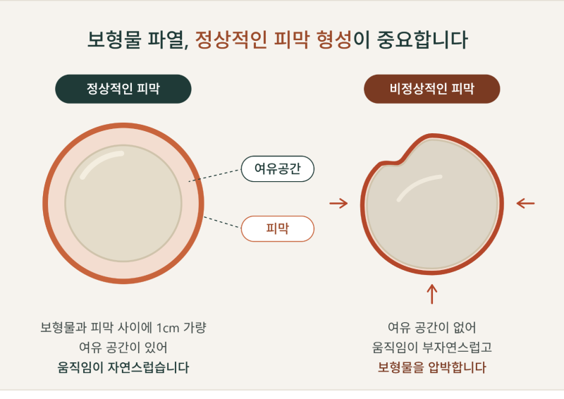 가슴 보형물 제거 후기 파열 증상 우려된다면?